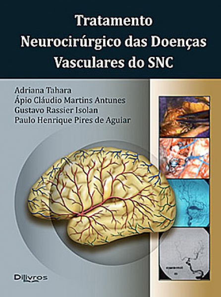Tratamento Neurocirurgico Das Doenças Vasculares Do Snc