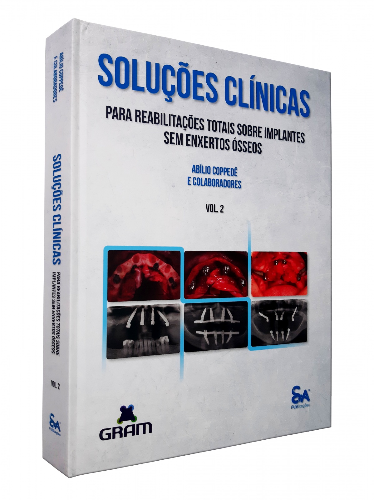 Soluções Clínicas Para Reabilitações Totais Sobre Implantes Sem Enxertos Ósseos - Vol. 2