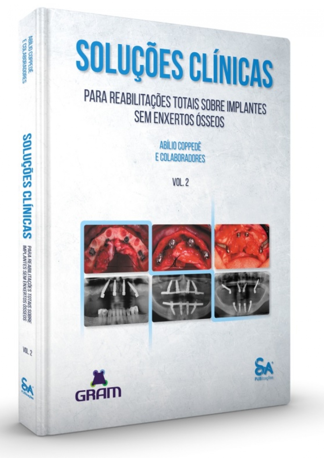 Soluções Clínicas Para Reabilitações Totais Sobre Implantes Sem Enxertos Ósseos - Vol. 2