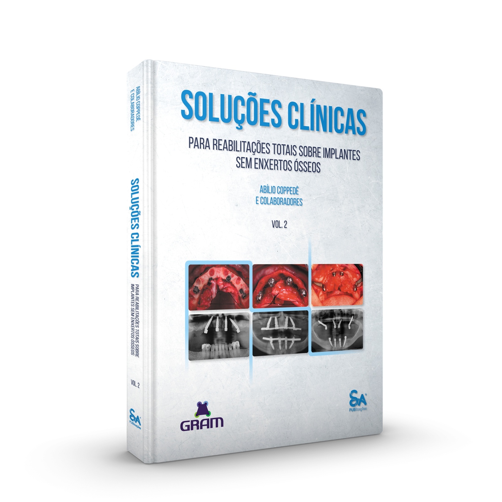 Soluções Clínicas Para Reabilitações Totais Sobre Implantes Sem Enxertos Ósseos - Vol. 2