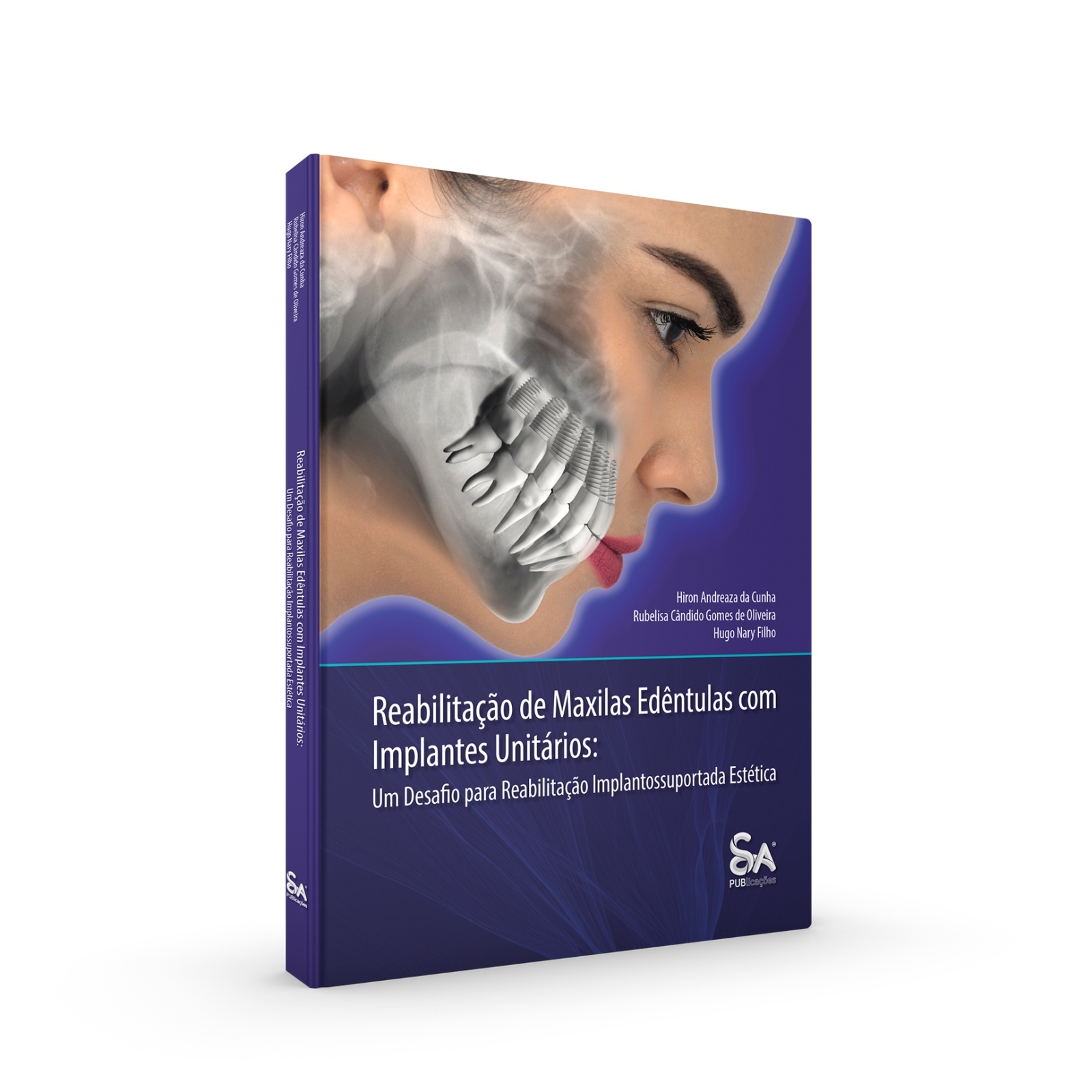 Reabilitação De Maxilas Edêntulas Com Implantes Unitários: Um Desafio Para Reabilitação Implantossuportada Estética