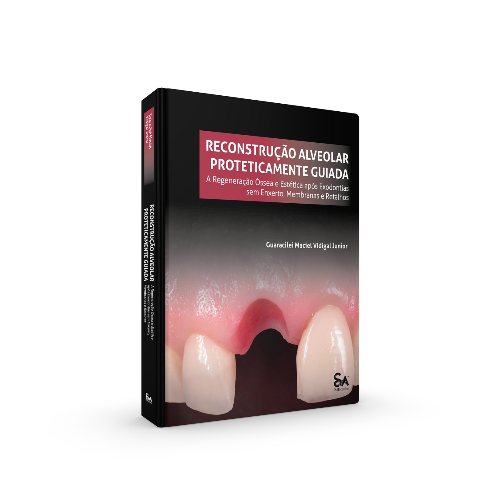 Reconstrução Alveolar Proteticamente Guiada: A Regeneração Óssea E Estética Após Exodontias Sem Enxerto, Membranas E Retalhos