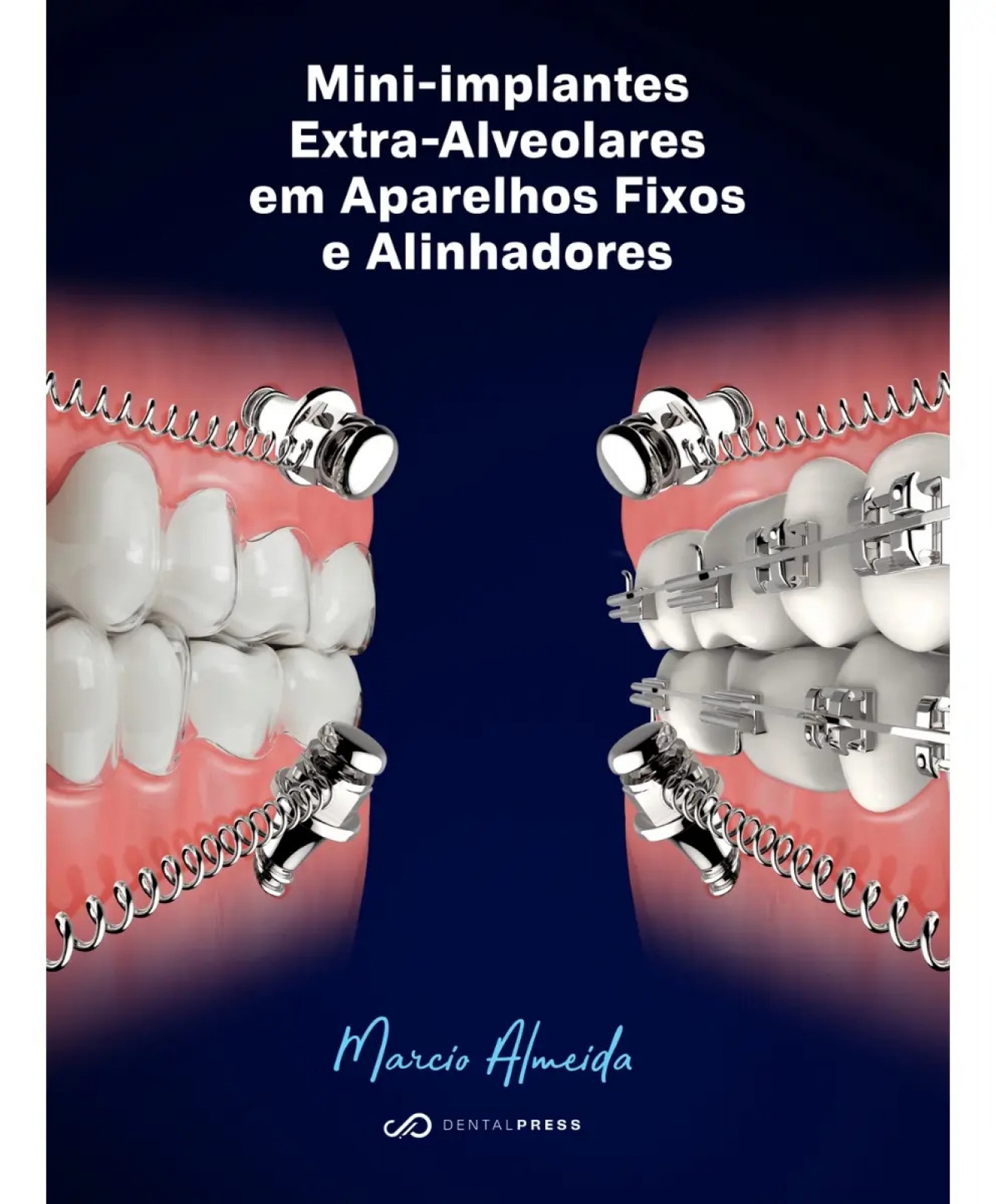 Mini-Implantes Extra-Alveolares Em Aparelhos Fixos E Alinhadores