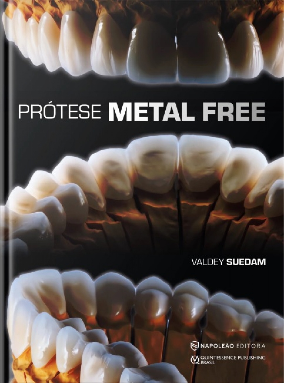 Prótese Metal Free