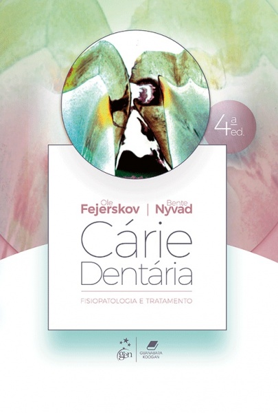 Cárie Dentária: Fisiopatologia E Tratamento