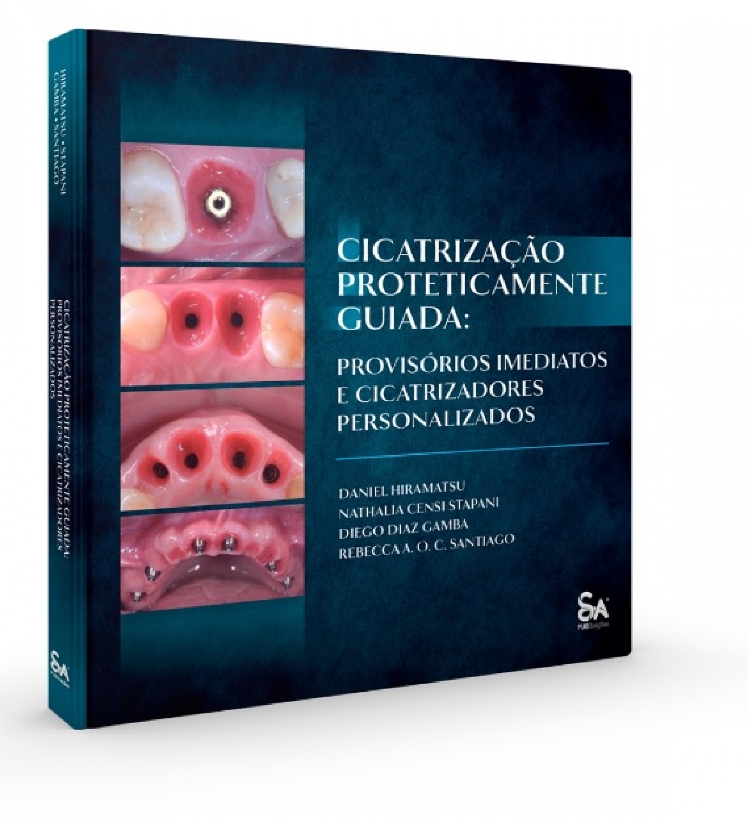 Cicatrização Proteticamente Guiada